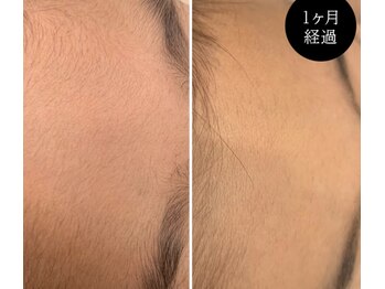 ヴィアス(vias)/顔脱毛