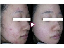 マイン 幸店/ドクターリセラADS美肌活性