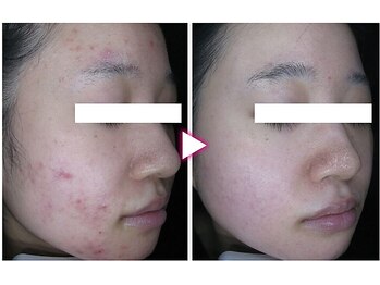 マイン 幸店/ドクターリセラADS美肌活性