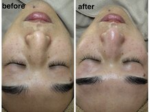 アネラ 本町(ANERA)/小顔矯正&毛穴洗浄BeforeAfter