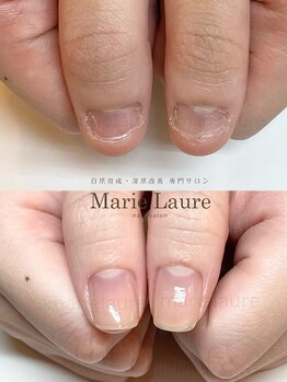 マリーロール 梅田店(Marie Laure)/深爪矯正/自爪育成/自爪風