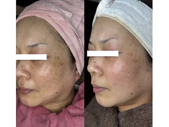 アニー(ANNIE)/HAAB REPRO