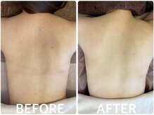 ハーブピーリング 恵比寿/背中ニキビ/くすみ