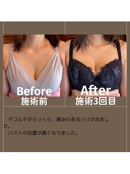 エミニナル(EMININAL)/【バストケア】ビフォーアフター
