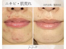 スリースリー(THREE THREE)/ニキビ・肌荒れケア