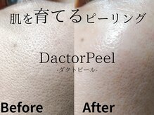 メイプル(Maple)/ぽっかり毛穴開きはコレ！！