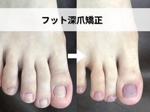 ブルームーンネイルズ(BLOOMOON.nails)/フット深爪矯正