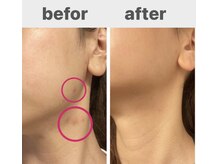 シャムリー 並木坂(Syamry)/ハーブピーリング1回