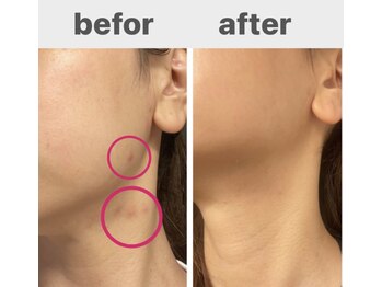 シャムリー 並木坂(Syamry)/ハーブピーリング1回