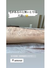 アムール(Amour)/メンズ脱毛ひざ下