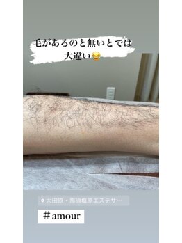 アムール(Amour)/メンズ脱毛ひざ下