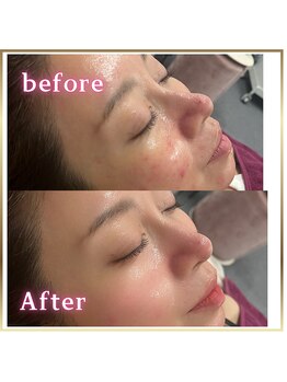 ピュアスキンサロン 恵比寿店(pure skin salon)/毛穴洗浄 ハイドラフェイシャル