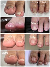 プリード 日進香久山店(PULIDO)/巻き爪ケアフレックスプレート