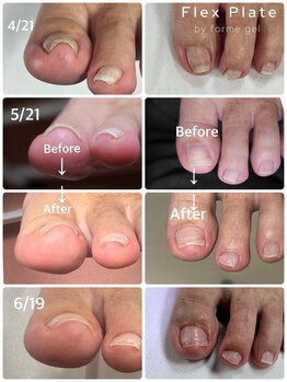 プリード 日進香久山店(PULIDO)/巻き爪ケアフレックスプレート