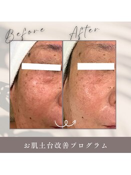 プレジール(plaisir)/お肌土台改善プログラム