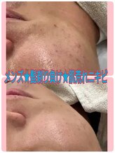 キッカ 梅田天六(Kikka)/メンズのニキビ＆肌荒れに！