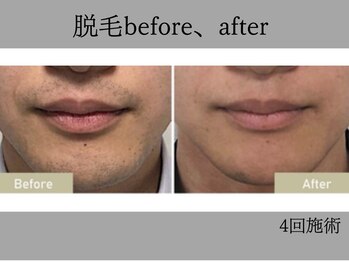 リル シャイン(Rill SHINE)/メンズヒゲ脱毛