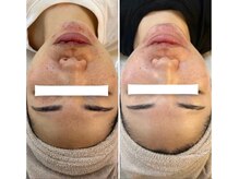 リノ ショウナン(LINO SHONAN)/before→after