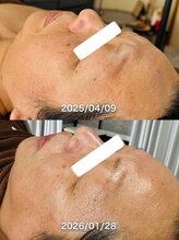 ルーク(Luke)/しわ/くすみ/たるみケア