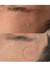 トータルビューティー ミミ(Total Beauty mimi)/プラズマニア施術【ニキビ】