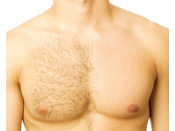 ミ カシータ(Mi casita)/人気の脱毛は２種類あります