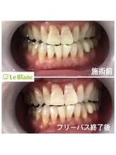 ルブラン 奈良店(Le Blanc)/歯も大掃除！！