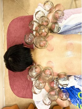 足浴堂/腕のカッピング