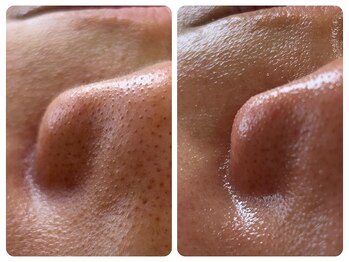 ウララカ(uraraca)/小鼻の悩み