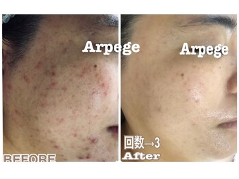 アルページュ(Arpege)/韓国肌管理ニキビケア♪肌改善