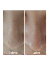 クリアビューティー(CLEAR BEAUTY)/ハイドラフェイシャル毛穴洗浄