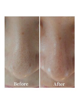 クリアビューティー(CLEAR BEAUTY)/ハイドラフェイシャル毛穴洗浄