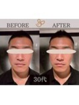 チョコバリ 錦糸町店(chocobari)/小顔×リフトアップ(美容鍼)30代