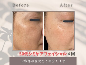 トータルビューティー雅/シミ・くすみを脱ぐ!美白ケア