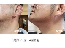 ダイアナ 出雲店(Daiana)/ヒゲ脱毛