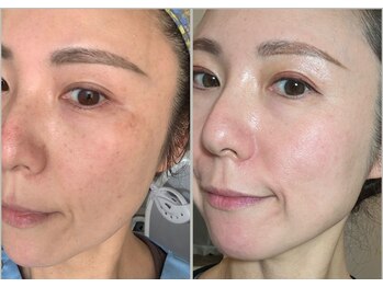 ナンバーナイン(No.9)/お肌は変わります