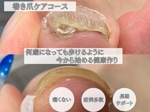巻き爪により将来歩けなくなる。そんなことのないようサポート