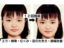 ニュートラル 渋谷店(NEUTRAL)/小顔矯正結果［小顔/骨盤］