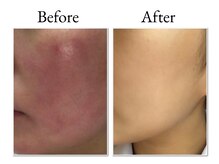 敏感肌の方にもオススメ◎(陶肌トリートメント)