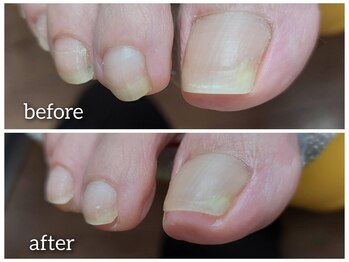 【巻き爪】クッション材でラクに