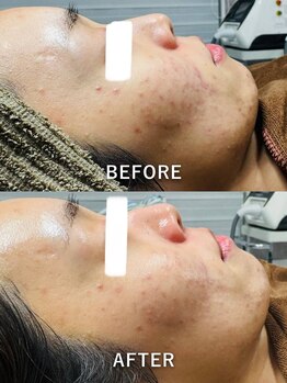 ルーク(Luke)/ニキビケア／くすみ／毛穴