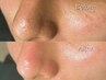 【60日以内｜鼻の黒ずみ・角栓に】眉毛WAX＋鼻集中の毛穴洗浄￥6000[新宿]